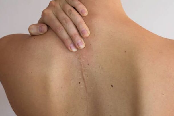 Tratamiento y prevención de las Cicatrices